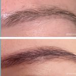 Before + After - Brow Loss