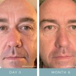 Before + After - Aging Skin