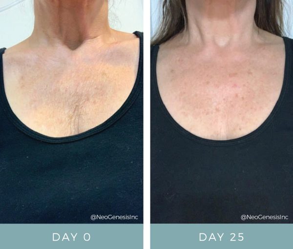 Before + After - Ageing Skin - Decolette