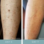 Before + After - Chemo Rash