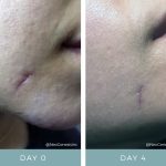 Before + After - Wound Care - Dog Bite