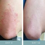 Before + After - Psoriasis