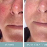 Rosacea - Before + After