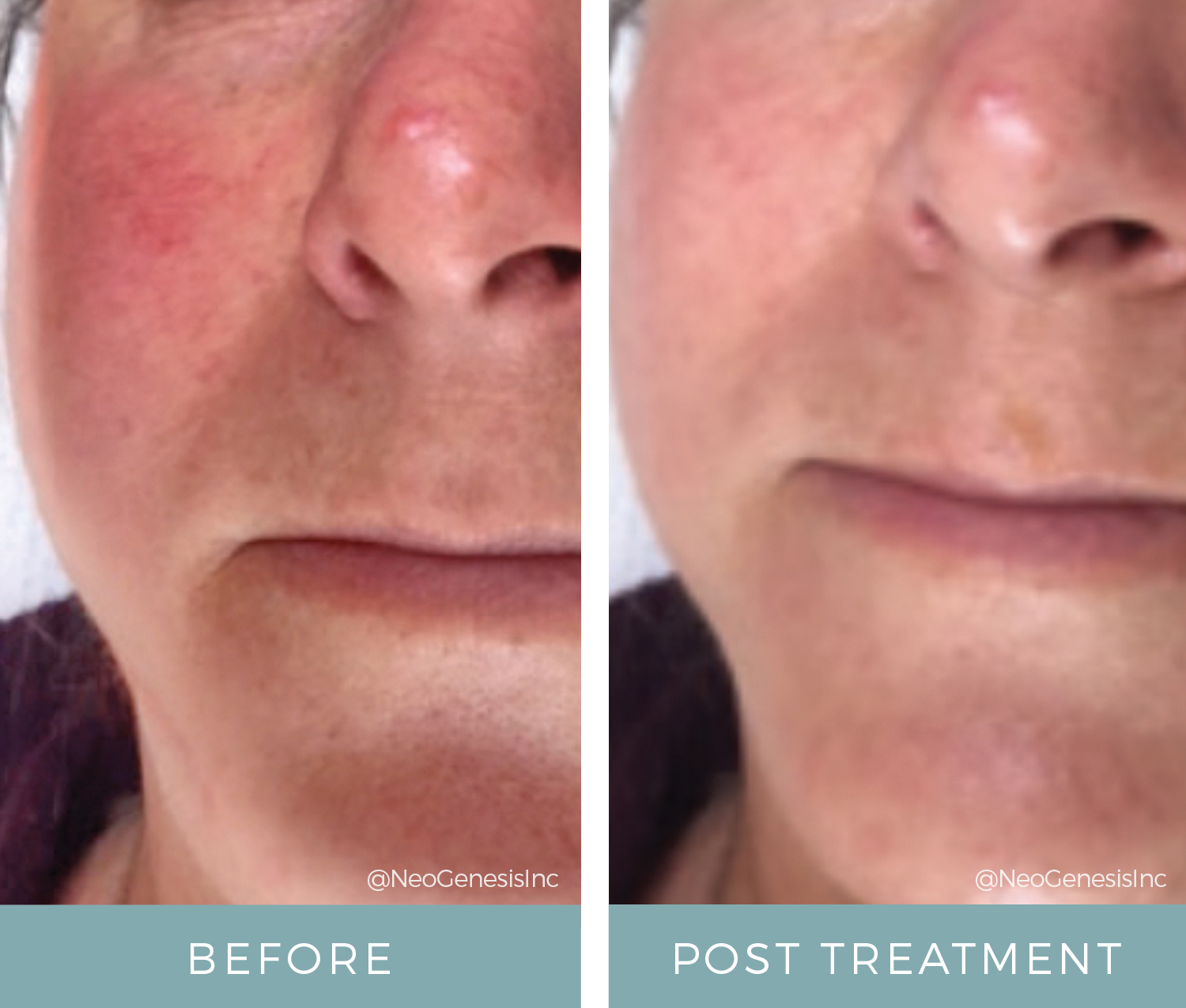 Rosacea - Before + After