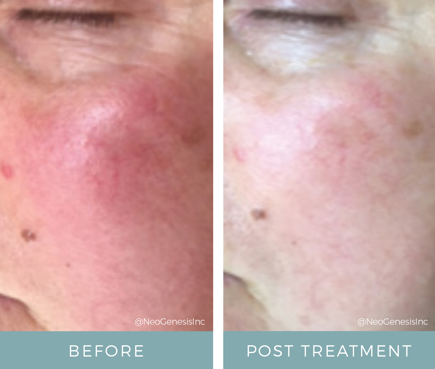 Before + After - Microcurrent and Rosacea