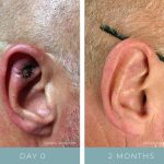 Before + After - Mohs Surgery - Skin Cancer Surgery