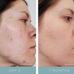Before and After - Acne 