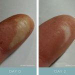 Before + After - Mechanic Burn