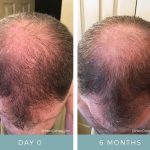 Before + After - Hair Loss