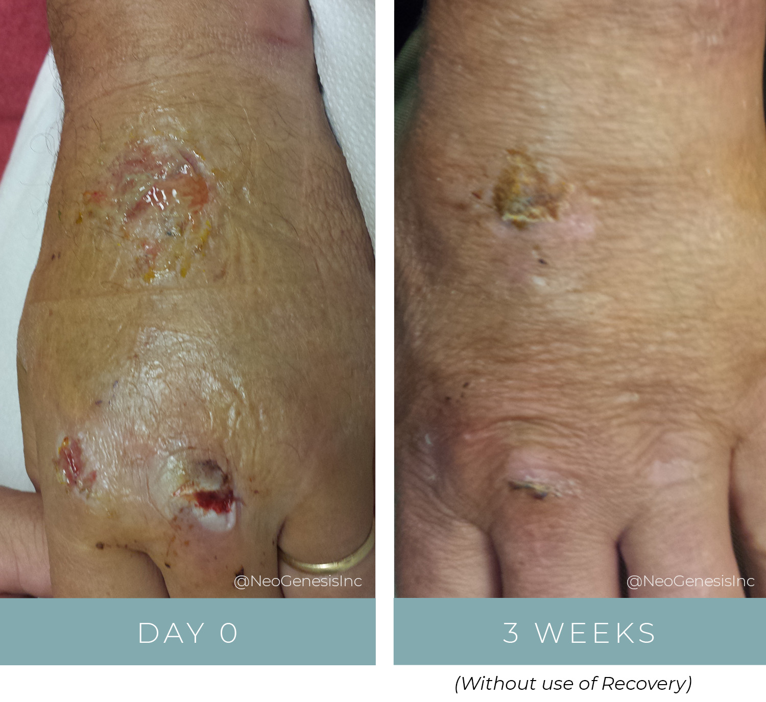 Before + After - Wound Care