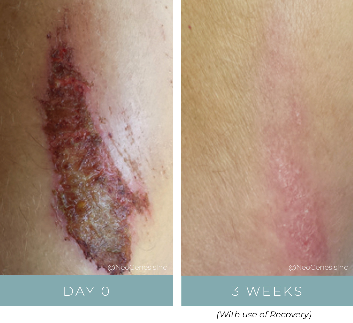 Before + After - Wound Care