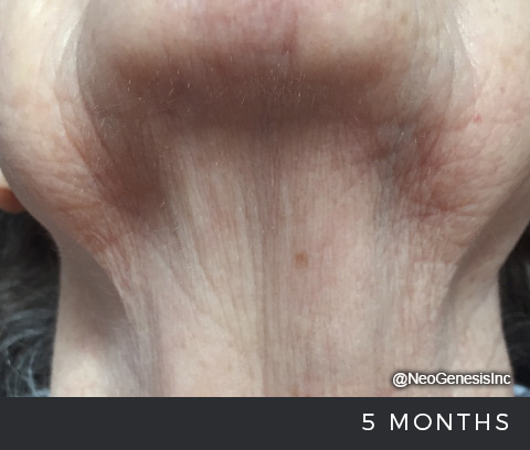 After - Ageing Skin - Neck