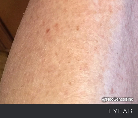 After - Cancer Surgery Scarring