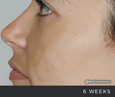 After - Hyperpigmentation