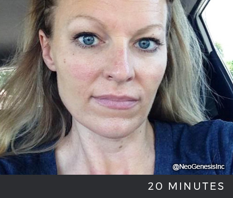 Microneedling - After NeoGenesis Skincare Products