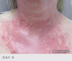 Effective Solutions for Radiation Dermatitis Relief