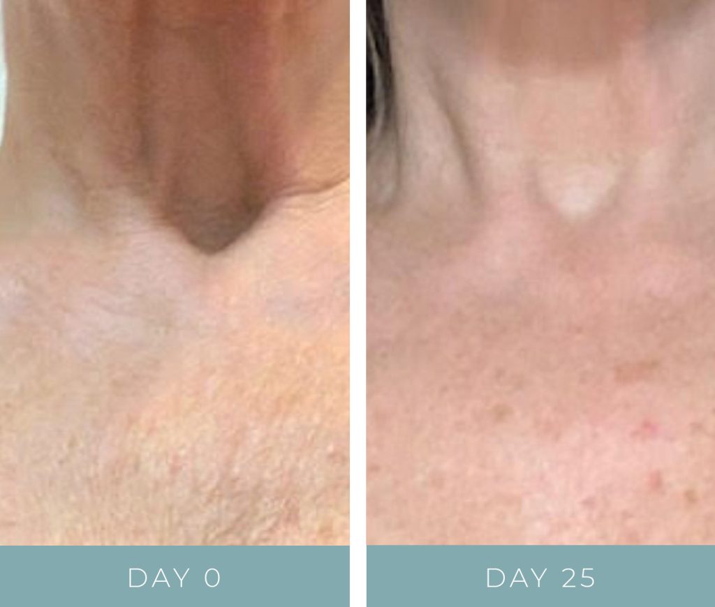 Before + After - Ageing Neck