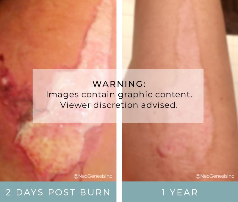 Wound Care for Hot Oil Burns NeoGenesis Recovery Serum