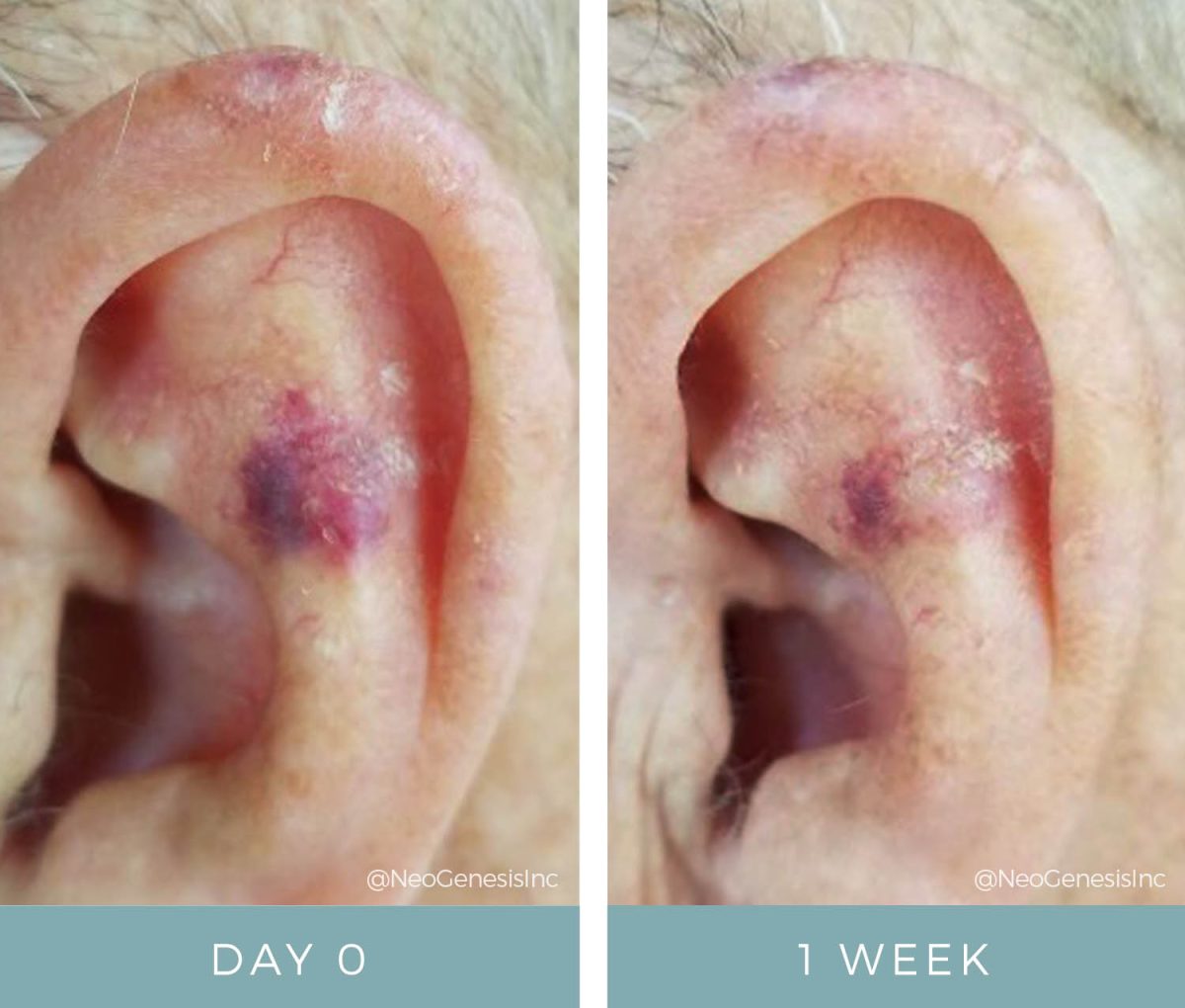 Chemo Rashes Topical Chemotherapy Side Effects Before + After NeoGenesis