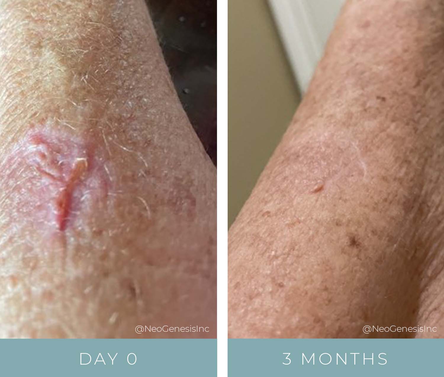 Scarring Reduction Before and After Transformation