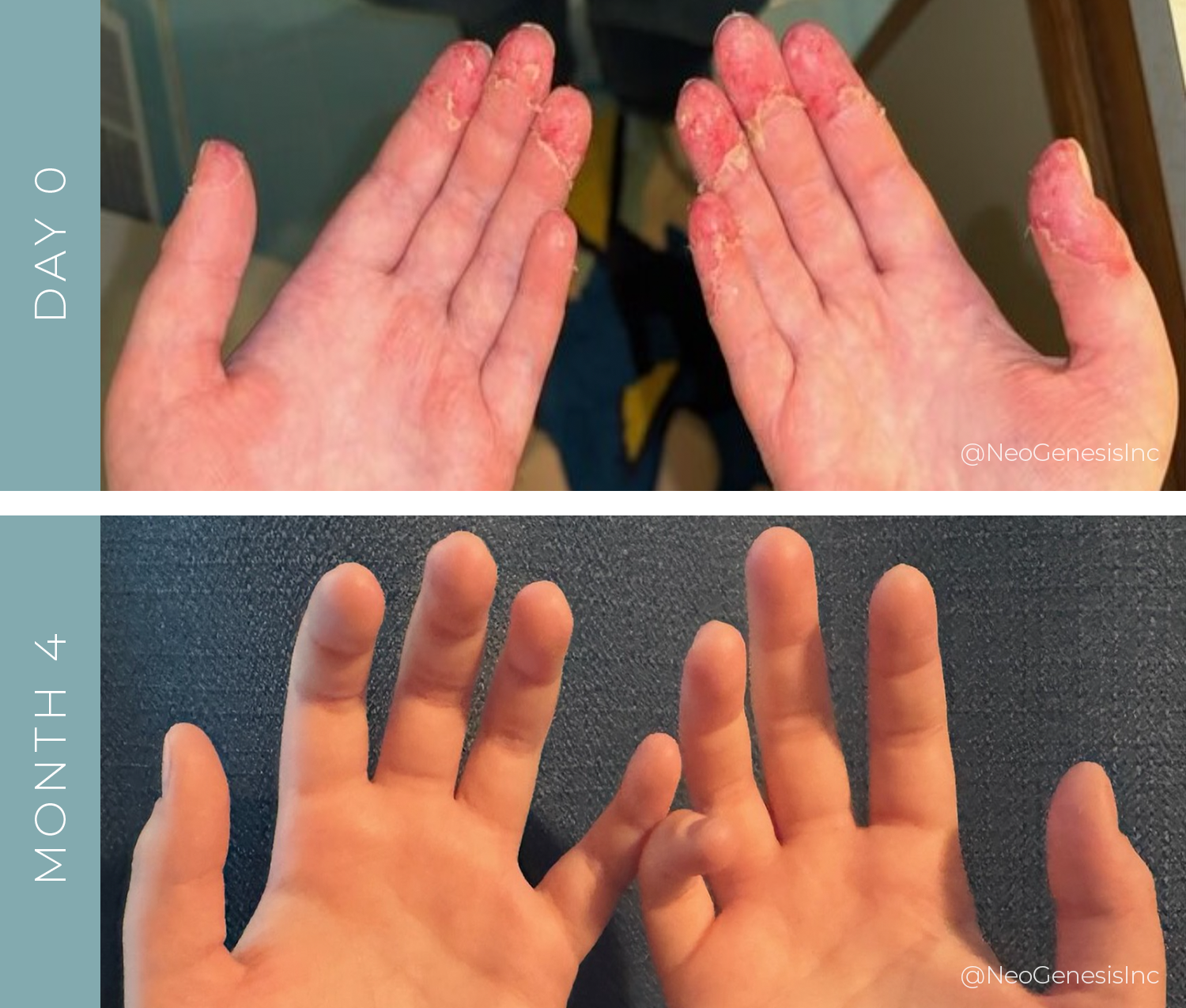 Before + After - Contact Dermatitis