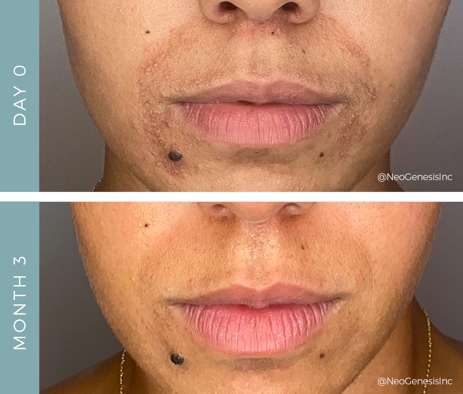 Before + After - Perioral Dermatitis