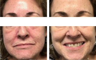 Before + After - Chemical Peel