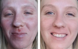 Before + After - Eczema