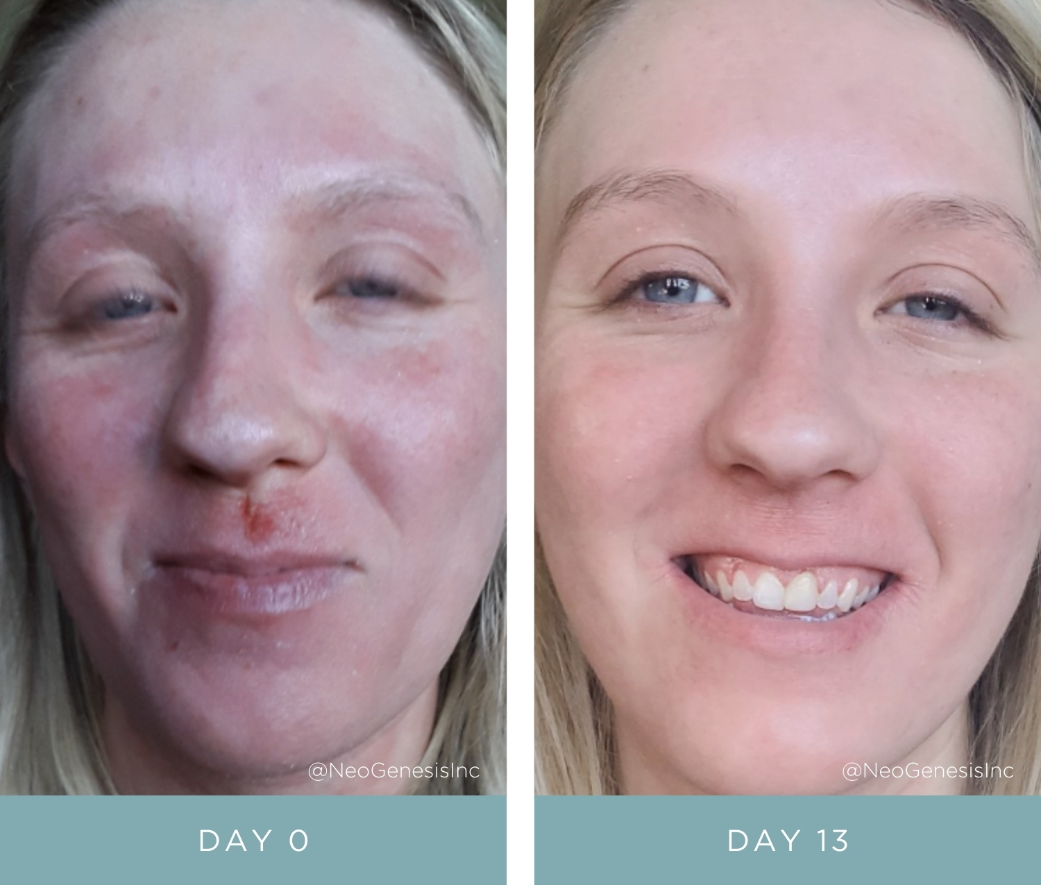 Before + After - Eczema